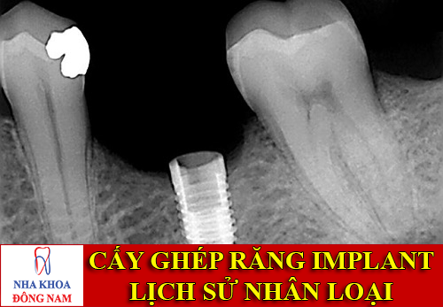 cấy ghép răng implant tạo nên lịch sử nhân loại -1