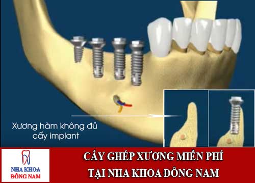 cay-ghep-xuong-mien-phi-tai-nha-khoa-dong-nam