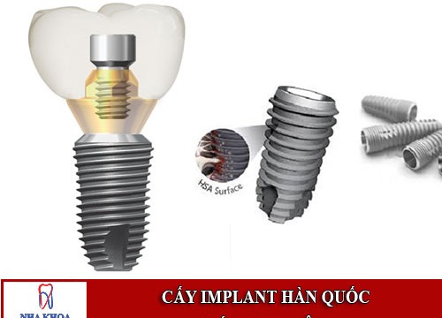 Cấy ghép Implant Hàn Quốc giá bao nhiêu?