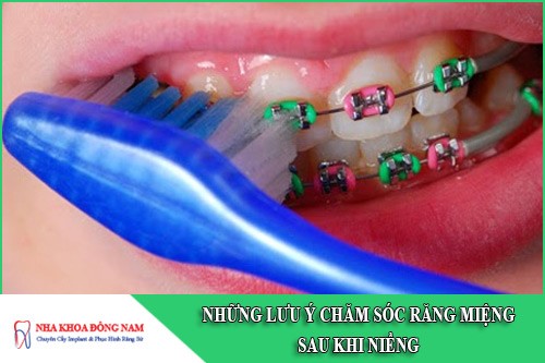 7 lưu ý chăm sóc răng miệng sau khi niềng