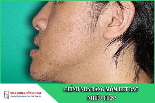 chỉnh nha răng móm hết bao nhiêu tiền