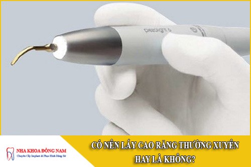 có nên lấy cao răng thường xuyên hay là không