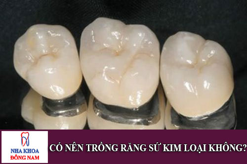 có nên trồng răng sứ kim loại không