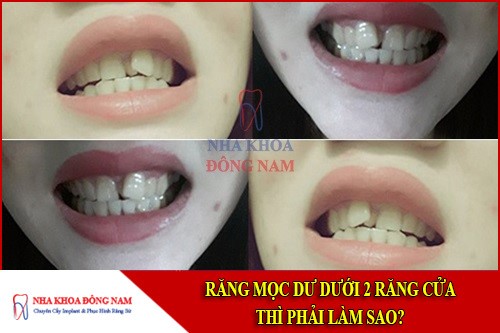 răng mọc dư dưới 2 răng của thì phải làm sao