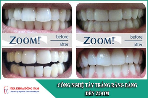 công nghệ tẩy trắng răng bằng đèn zoom
