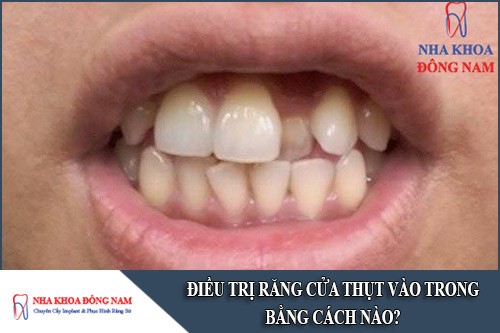 điều trị răng cửa thụt vào trong bằng cách nào
