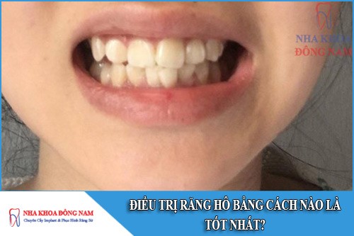 điều trị răng hô bằng cách nào là tốt nhất