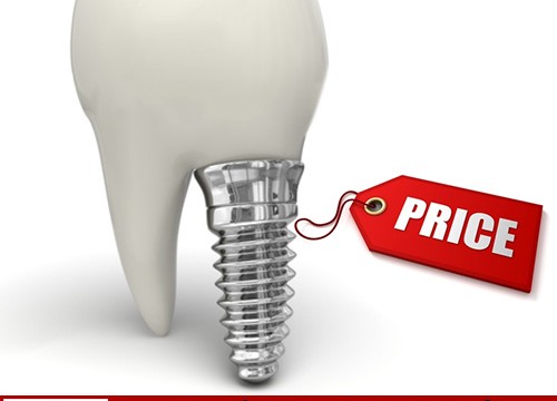 Bảng giá tiền trồng các loại răng giả tốt nhất hiện nay