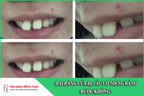 hai răng cửa bị vẩu có niềng răng được không