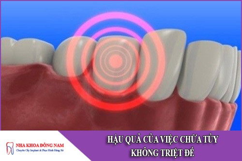 hậu quả của việc chữa tủy không triệt để