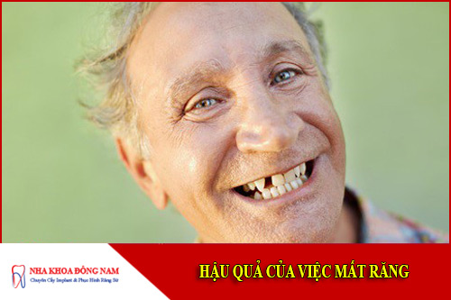 hậu quả của việc mất răng