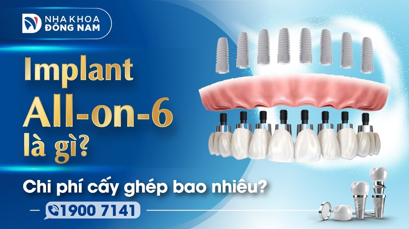 Implant All-on-6 là gì và chi phí cấy ghép bao nhiêu