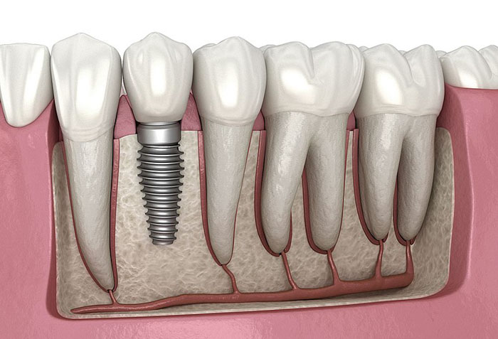 Implant nha khoa là sản phẩm quốc tế được công nhận và sử dụng trên toàn thế giới