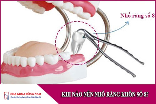 khi nào nên nhổ răng khôn số 8