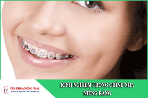 kinh nghiệm trong chỉnh nha niềng răng