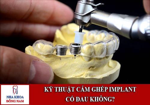 ky-thuat-cam-ghep-implant-co-dau-khong