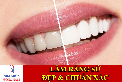 làm răng sứ như thế nào là đẹp và chuẩn xác -1