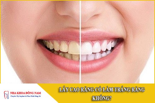 lấy cao răng có làm trắng răng không