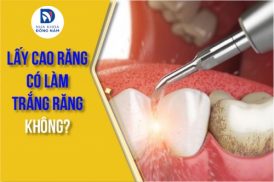 lấy cao răng có làm trắng răng không