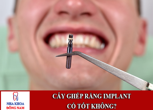 Lo lắng cấy ghép răng Implant có tốt không1