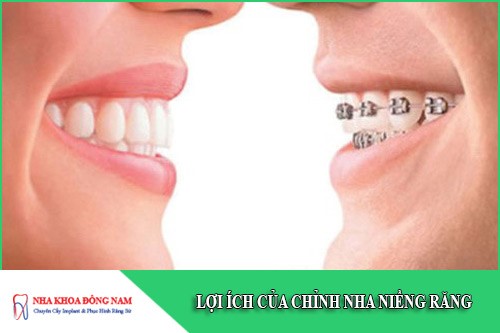lợi ích của chỉnh nha niềng răng