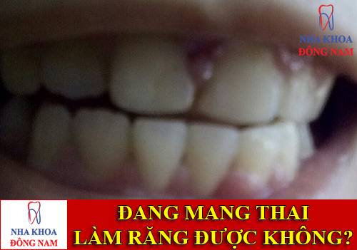 mang thai có làm răng sứ được không -1