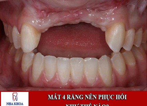 Mất 4 răng liên tiếp nhau thì phục hồi lại như thế nào?