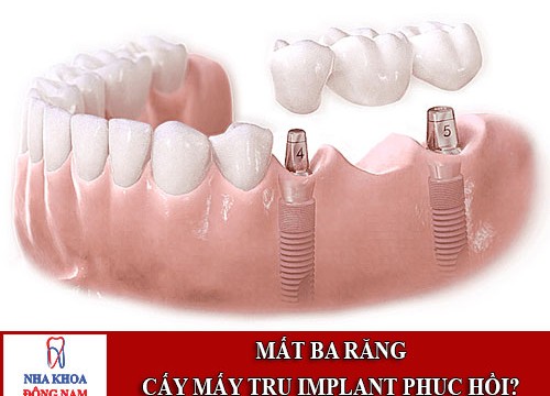 Mất ba răng nên cấy mấy trụ implant để phục hồi