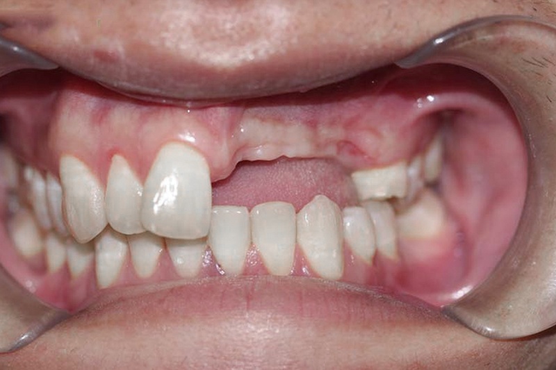 Mất răng chưa chắc đã được miễn nghĩa vụ quân sự