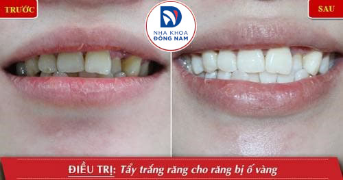 Màu sắc trắng sáng của răng sau khi tẩy duy trì được 1 - 3 năm