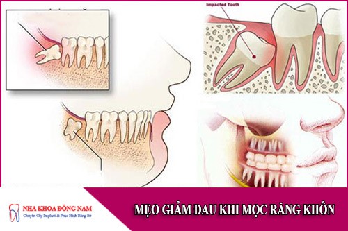 mẹo giảm đau khi mọc răng khôn