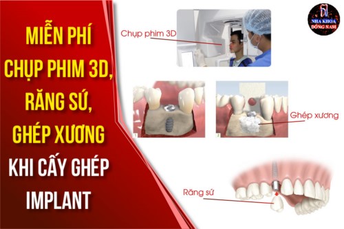 Miễn phí chụp CT, Răng Sứ, Ghép Xương khi cấy ghép Implant