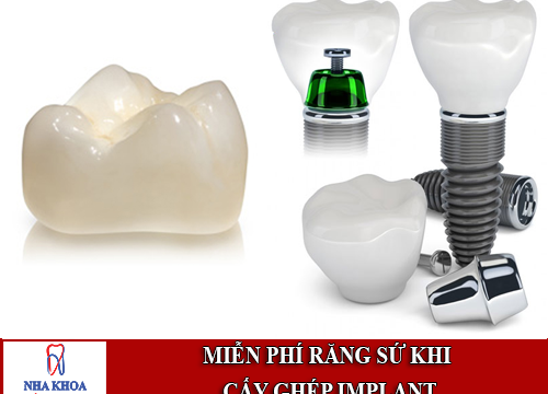 miễn phí răng sứ khi cấy ghép implant tại Nha khoa Đông Nam 5