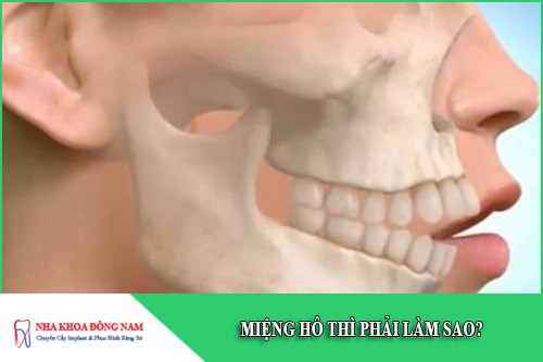 miệng hô thì phải làm sao