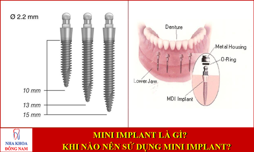 Mini Implant là gì? Khi nào nên sử dụng mini implant