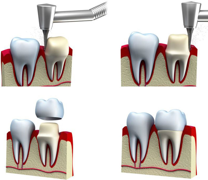 Mô phỏng kỹ thuật bọc răng sứ