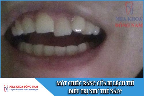 một chiếc răng cửa bị lệch thì điều trị như thế nào