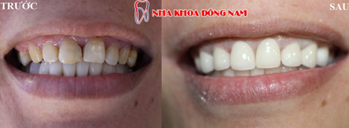 muốn làm dài răng ra thì làm bằng cách nào -2