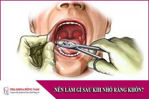nên làm gì sau khi nhổ răng khôn