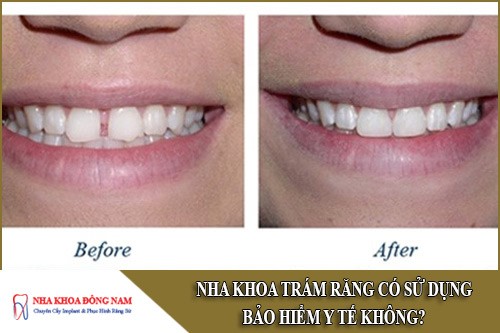 nha khoa trám răng có sử dụng bảo hiểm y tế không