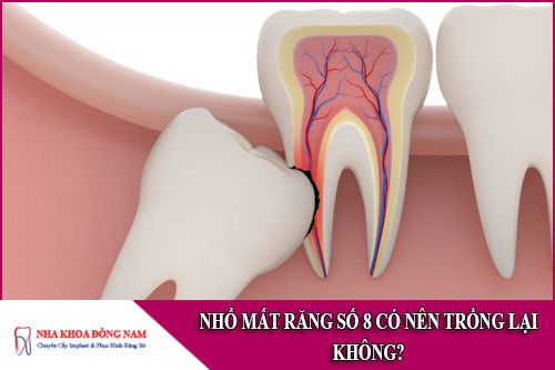 nhổ mất răng số 8 có nên trồng lại không