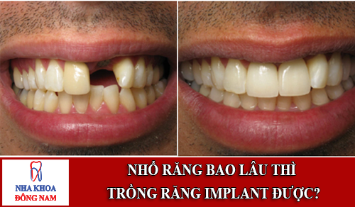 Mất răng bao lâu thì có thể trồng răng implant được 1