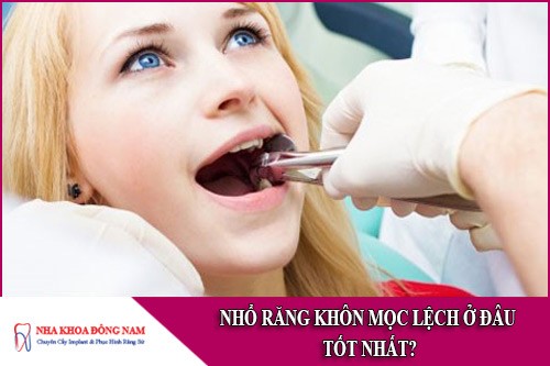 nhổ răng khôn mọc lệch ở đâu tốt nhất