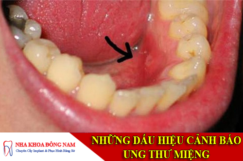 những dấu hiệu cảnh báo ung thư miệng -1
