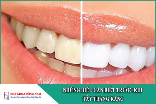 những điều cần biết trước khi tẩy trắng răng