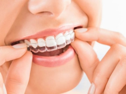 đeo máng ngậm tẩy trắng răng