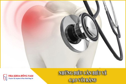 những điều cần biết về cạo vôi răng