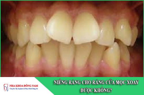 niềng răng cho răng cửa mọc xoay được không