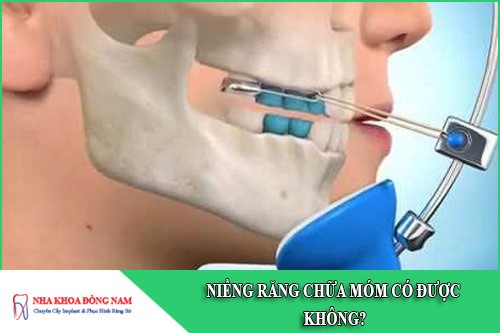 niềng răng chữa móm có được không