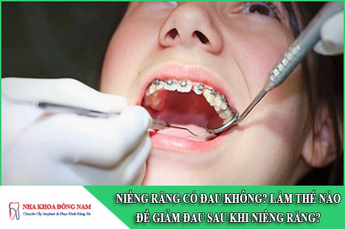 niềng răng có đau không